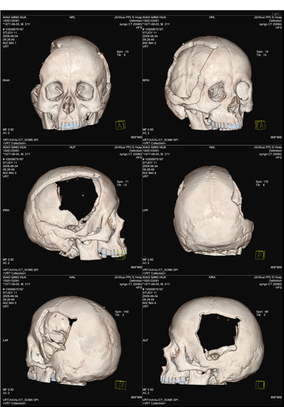 医用CT胶片-头骨