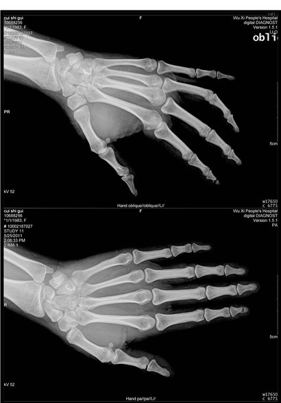 医用DR胶片-手骨