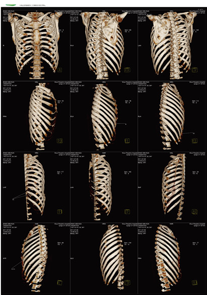医用CT胶片-肋骨